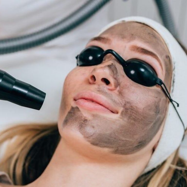 Carbon Laser Peel 1
