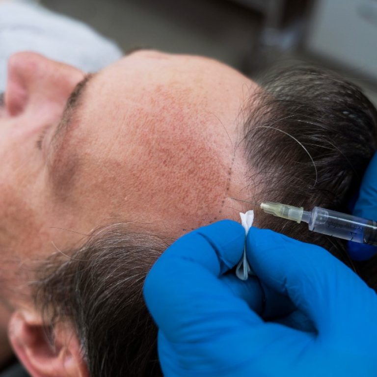 Hair Transplantation - 2