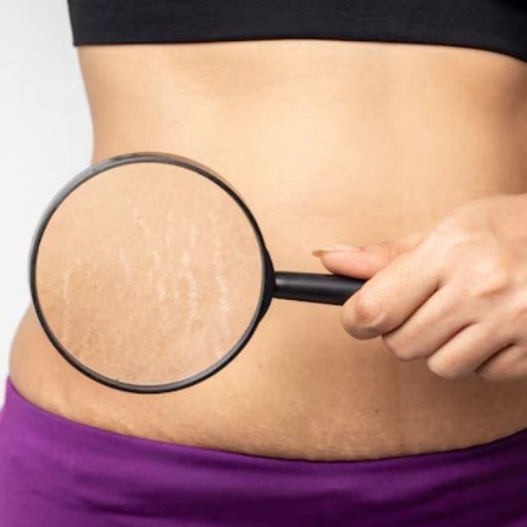 Scar Reduction 2